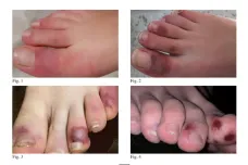 Covidové prsty mohou vydržet až půl roku, ukazují studie